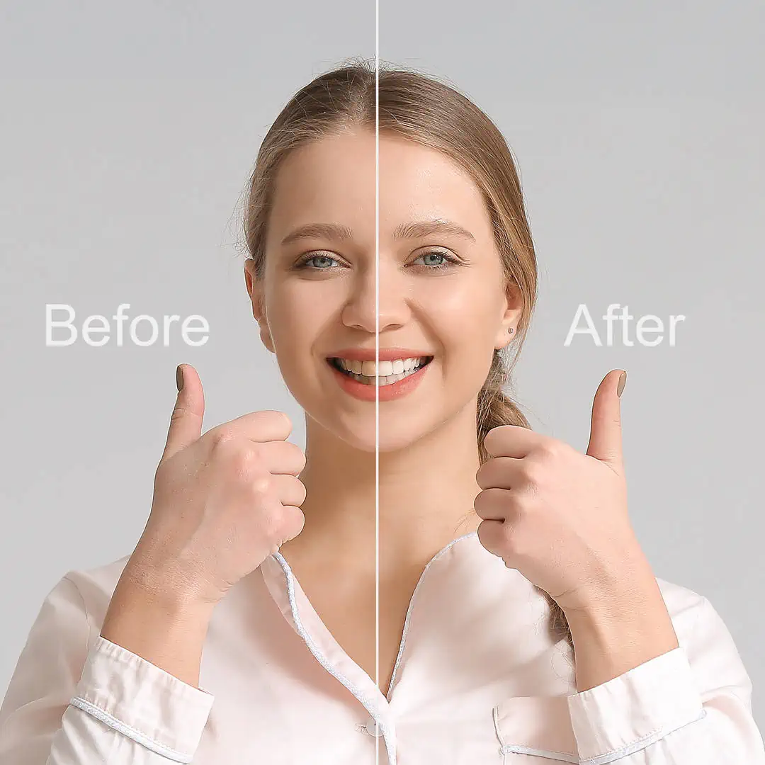 Close-up of a flawless smile after a veneer makeover