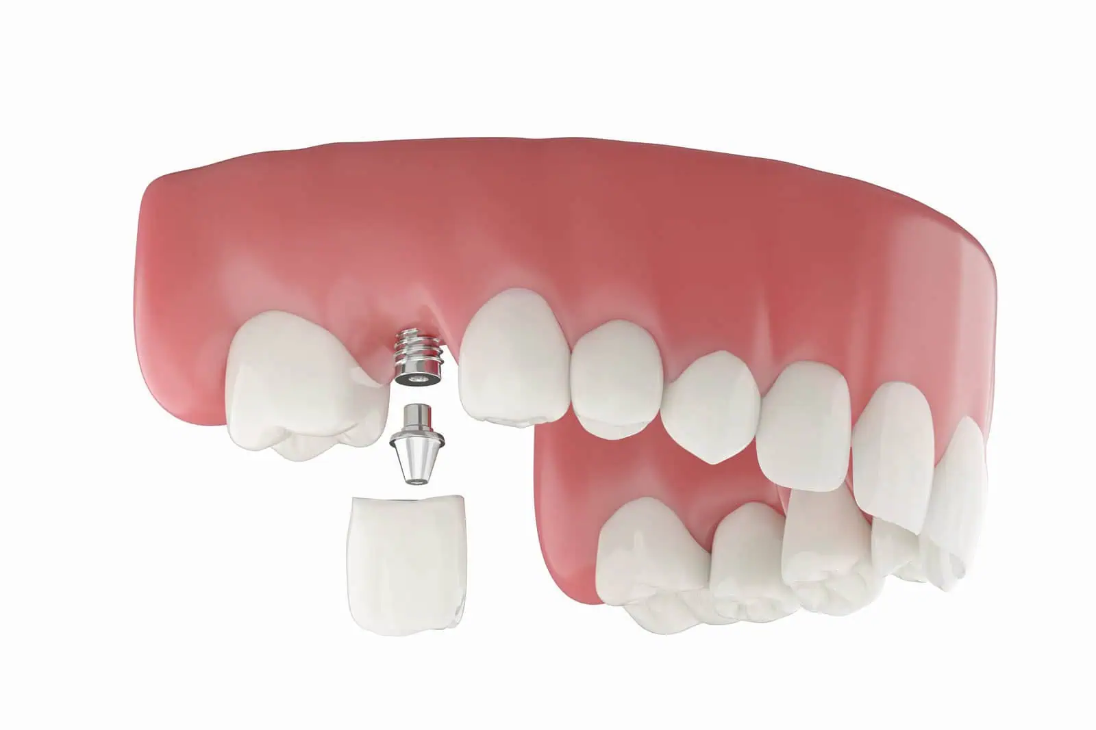 Model of a single tooth dental implant